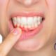 periodontitis-gingivitis-periodoncista las palmas-odontologos las palmas-dentistas las palmas-clinica lopez quevedo