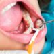 caries interproximal-caries-dentistas en las Palmas-ol