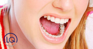 ortodoncia lingual-dentistas las palmas