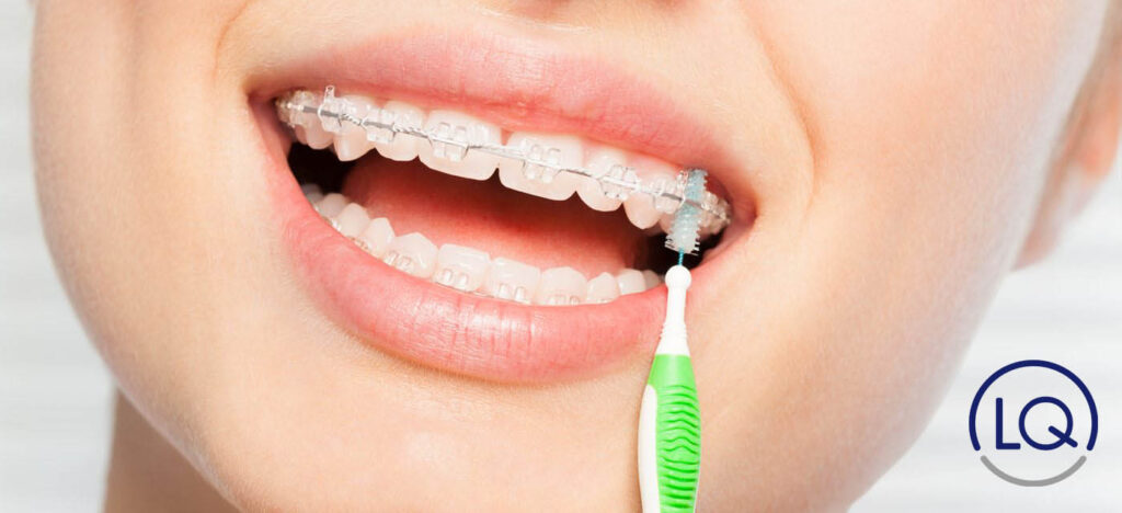 cómo limpiar los brackets-aparato de ortodoncia-dentistas Las Palmas-dentista las palmas-clinica dental las palmas-clinica lopez quevedo